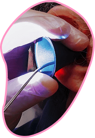 Ear Wax Removal (both ears)